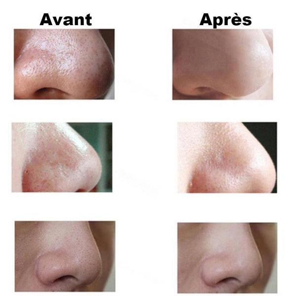 Aspirateur Electrique de Peaux Mortes