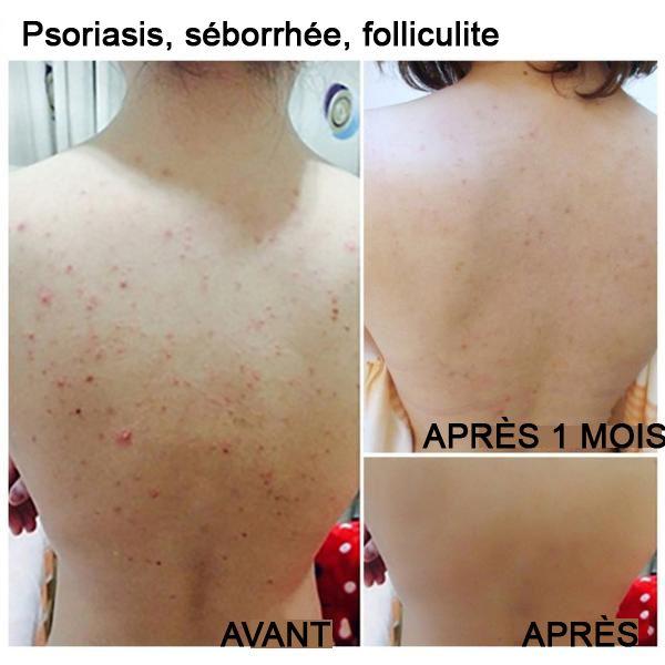 Savon Sel de Mer - Traitement Acné